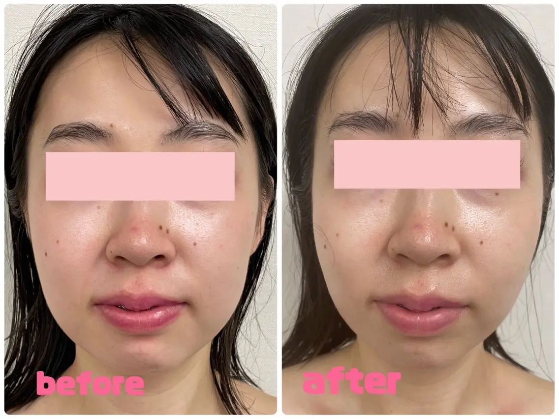 大人気‼️痛くない小顔コルギ【リフトアップヘッドマッサージ】付の写真