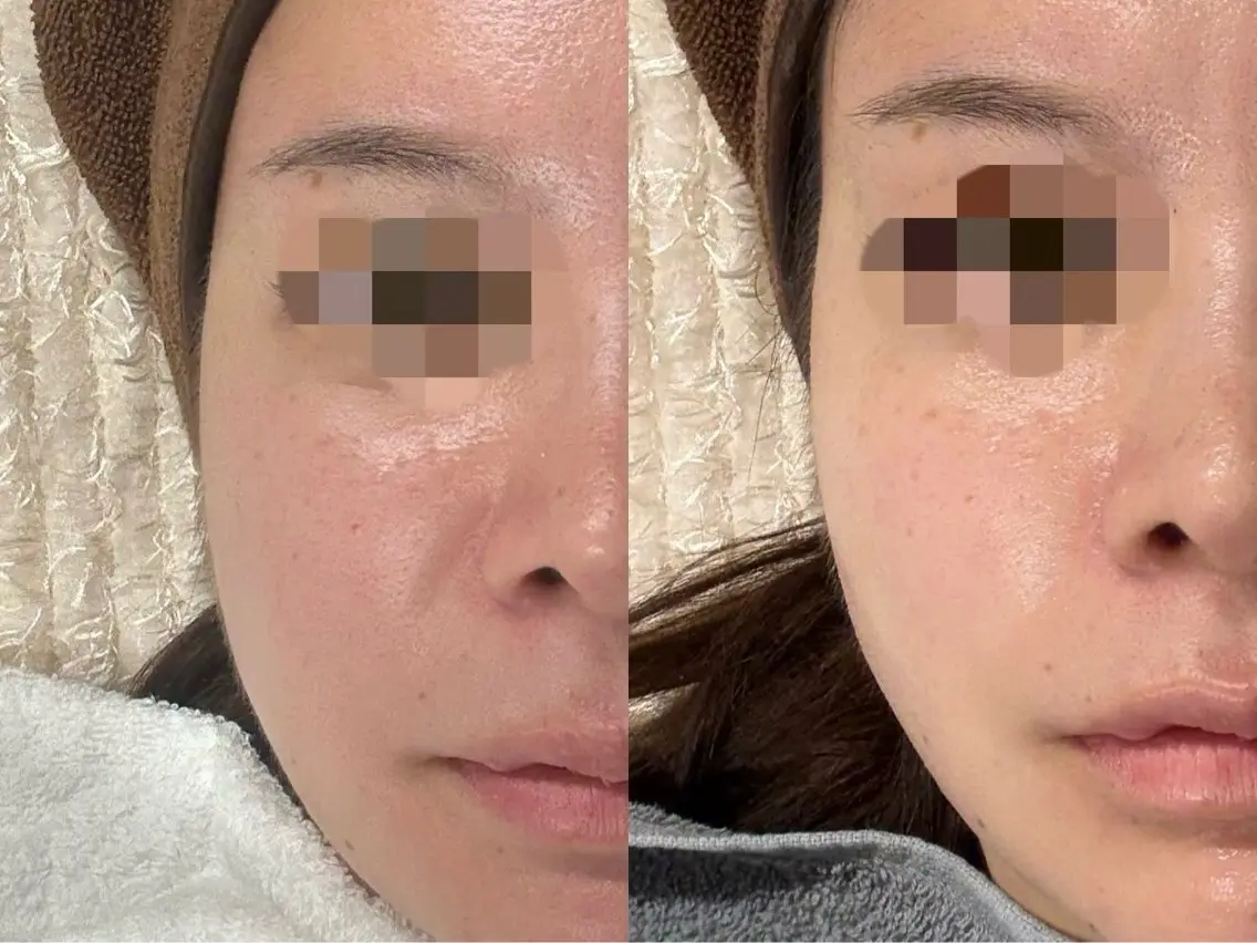 【都度払い】諦めていた凸凹肌を魅せる肌に◎クレーターにお悩みの方へ[カウンセリングからお客様に合ったメニューを相談]の写真