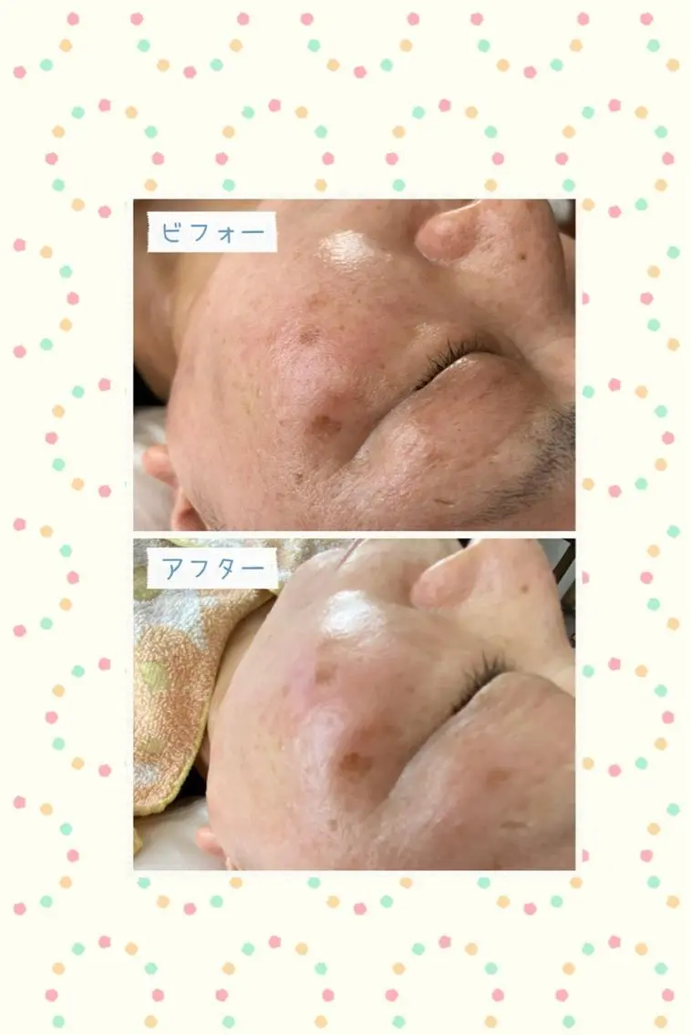 ♦️美白重視♦️マイルド美肌フェイシャル６０分（乳酸ピーリング+導入+マッサージ+パック）の写真
