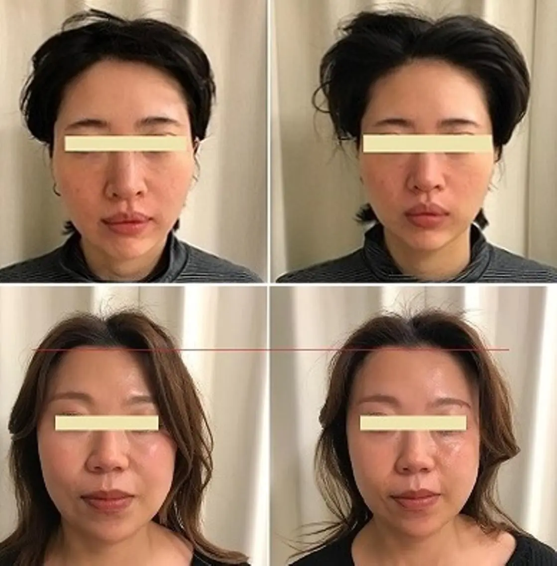 【たるみ改善+小顔】オンダリフティング:もはやオペ級!最新の切らない美容形整術の写真