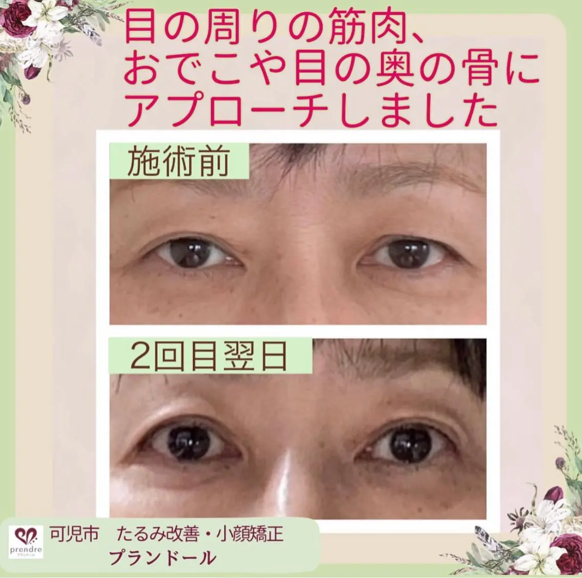 リフトアップ小顔矯正 いまいあやののその他イメージ