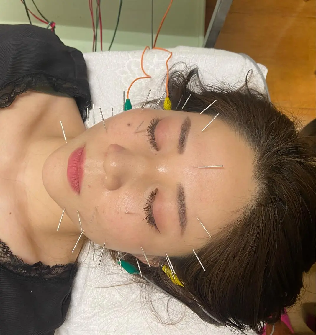 【初回お試しクーポン💫】美容鍼+小顔矯正のセットの写真
