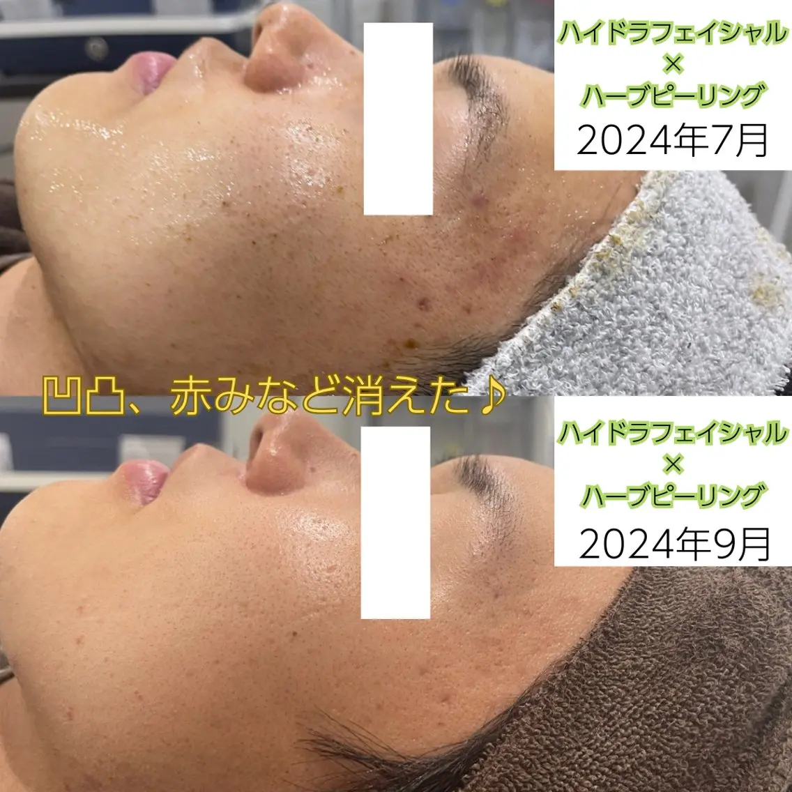 【初回体験】ニキビ跡があるメンズにもおすすめ！徹底毛穴！ツルピカ水光肌✨ハイドラフェイシャル&ハーブピーリング🌿の写真