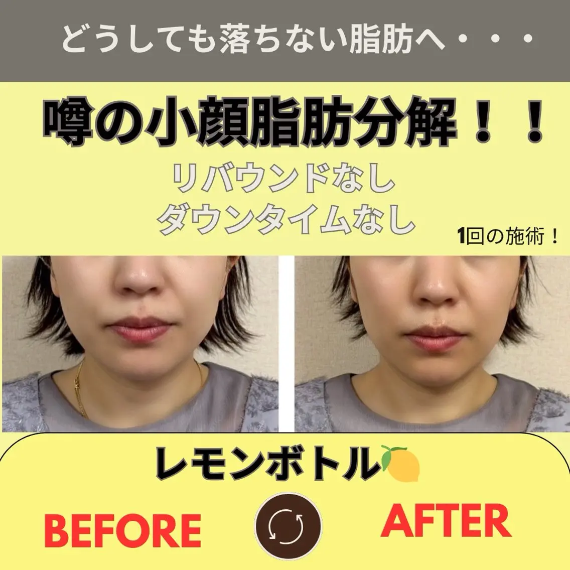 【結果重視】最新マシンで導入レモン ボトル【横顔美人】キレイなフェイスラインへ!フェイスマスクつきの写真