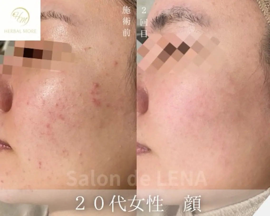 💫人気No.2💫【本気の肌改善🌿】剥離なしハーブピーリング+高濃度鎮静パック💆♀️🫧顔限定💆🫧の写真