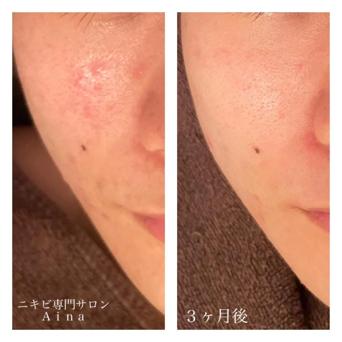 ミディアム カラー パーマ ヘアアレンジ メンズ キッズ ネイル マツエク・マツパ ニキビ跡専門サロン Ａｉｎａのエステ・リラクイメージ