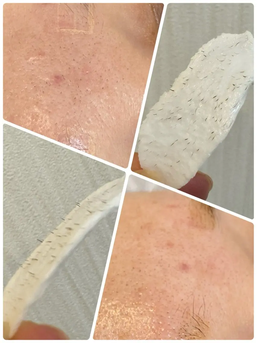 フェイシャルWAX脱毛の写真