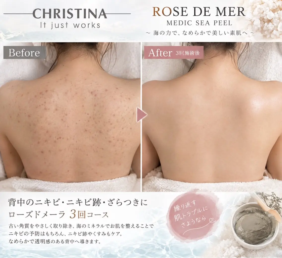 本気の集中ケア★ローズドメーラ3回コースの写真