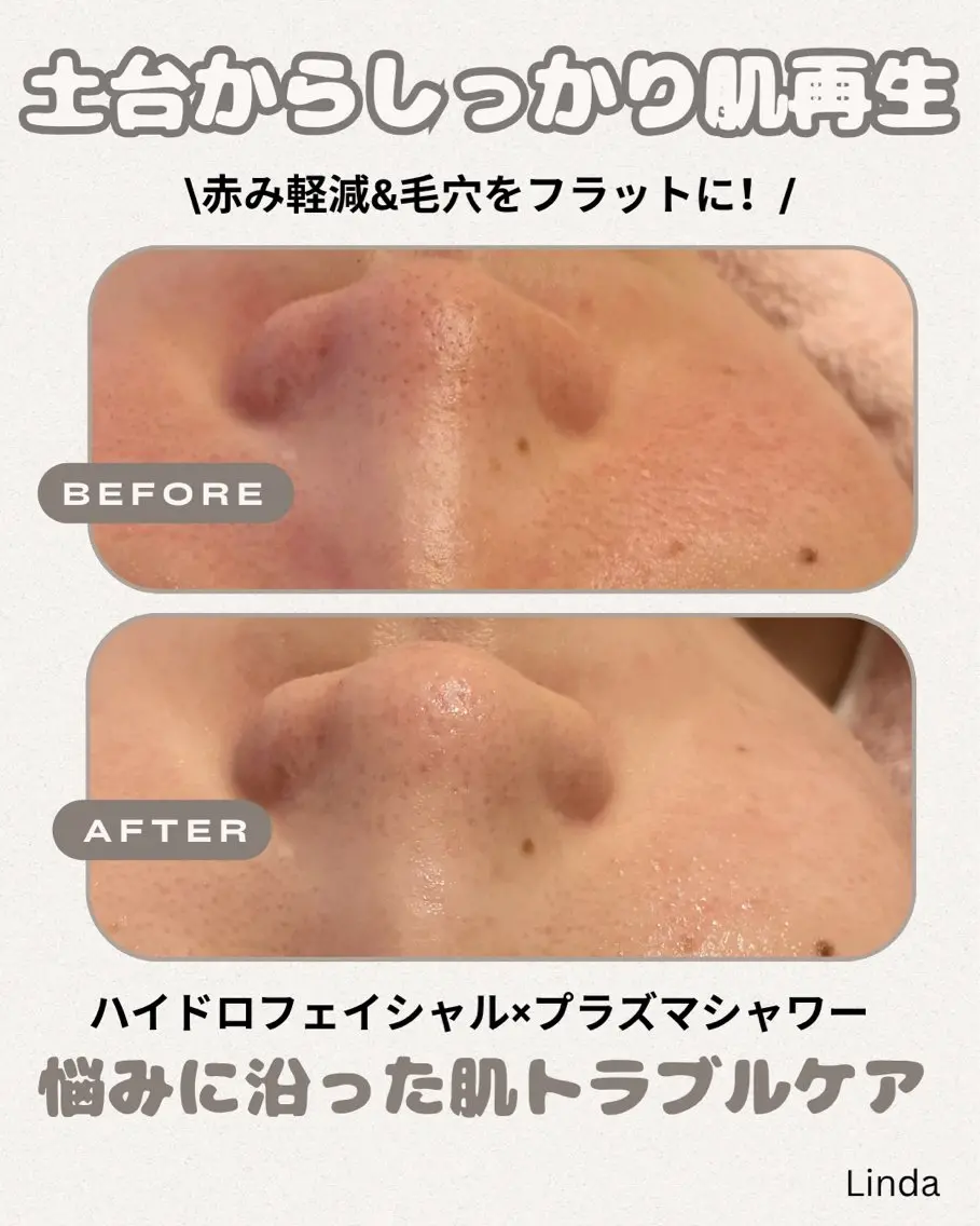 エステ 小顔&毛穴・肌質改善 LINDA西宮 AIのエステ・リラクイメージ