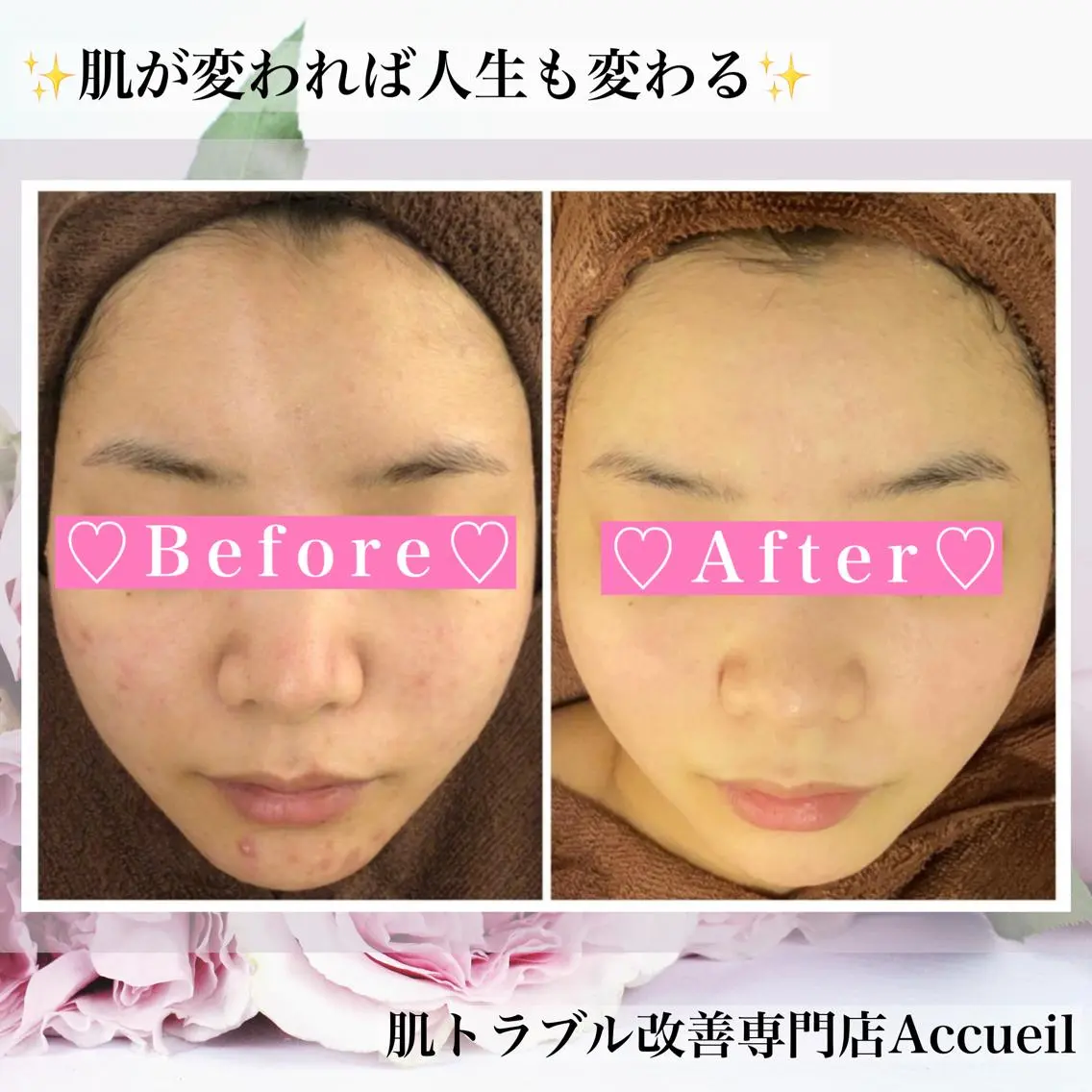 ミディアム カラー パーマ ヘアアレンジ メンズ キッズ ネイル マツエク・マツパ アイブロウ エステ リラク ニキビ・肌質改善専門 ♡人生が変わるサロンのエステ・リラクイメージ