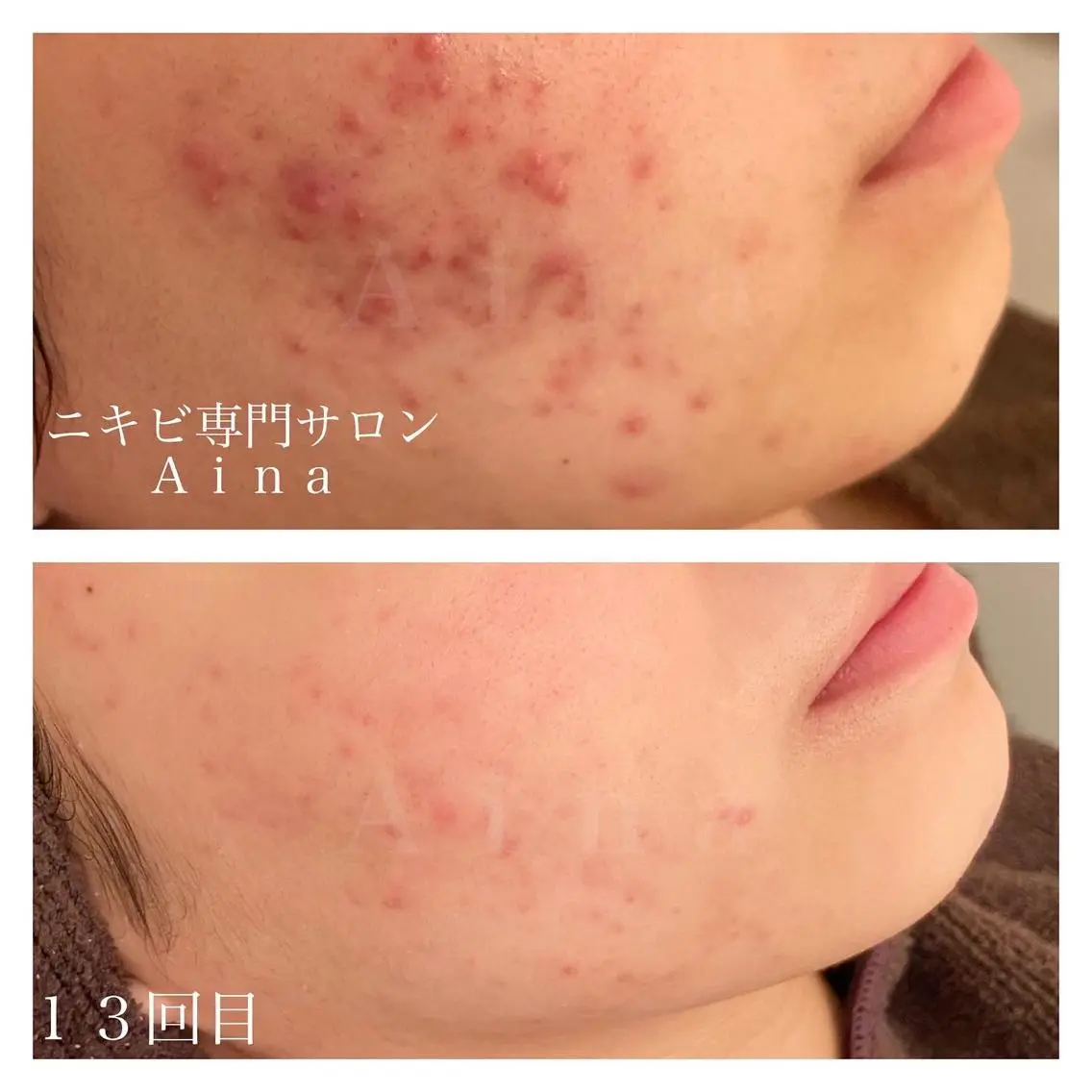 セミロング カラー パーマ ヘアアレンジ メンズ キッズ ネイル マツエク・マツパ エステ リラク ニキビ跡専門サロン Ainaのエステ・リラクイメージ