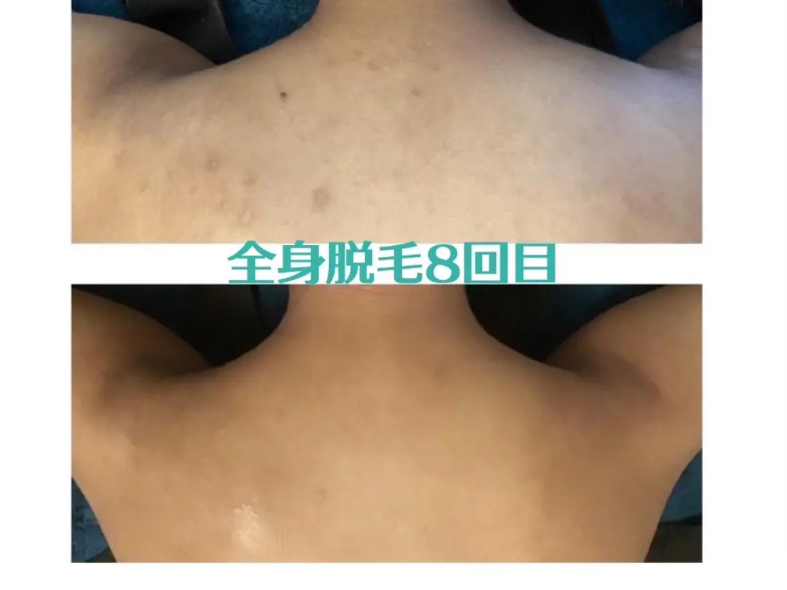 【ミニモSALE】2機種で脱毛最短卒業★全身◆60分間1回9,900脱毛体験の写真