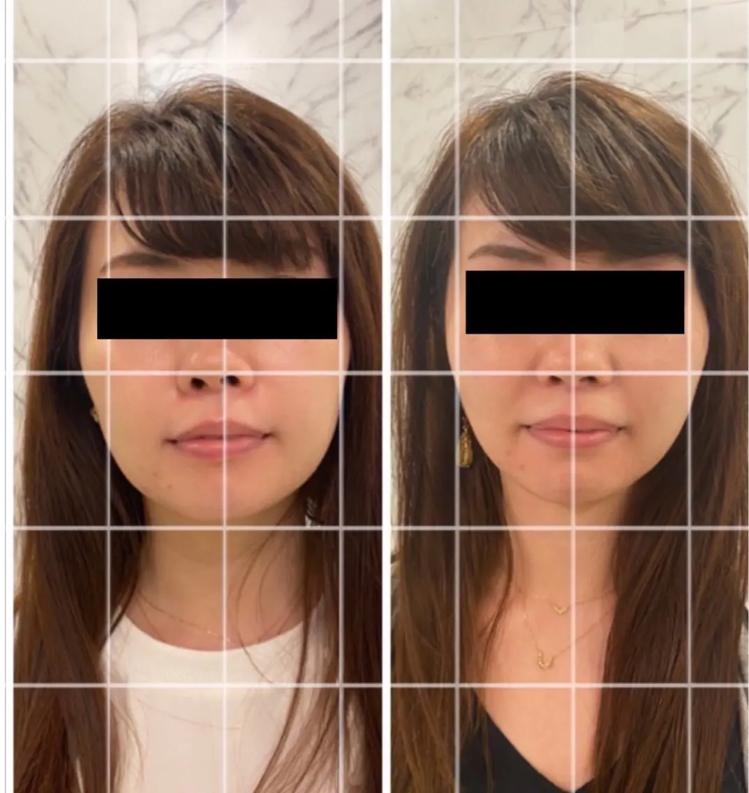 小顔リフトアップ効果⤴️最新NR機器を使用❣️の写真
