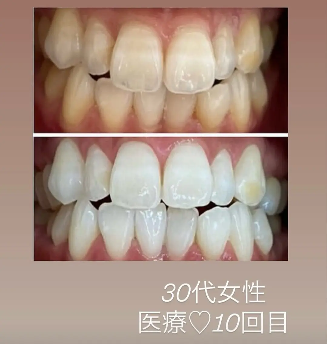 歯科提携ホワイトニング都度払い45分照射(15分×3照射)🦷🩵の写真
