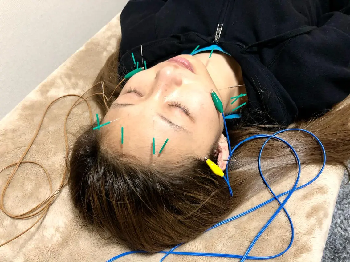 口コミを書いてくださる方限定⭐️   美容針＋電気＋小顔矯正＋肩甲骨はがし✨肩から楽になり、お顔も綺麗になりませんか？の写真