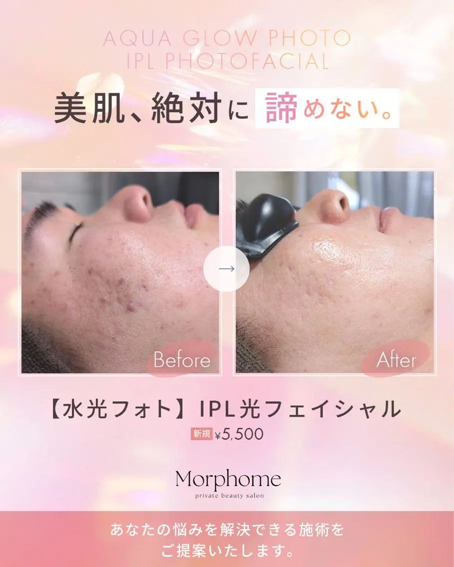 【水光フォト🫧|韓国肌管理】IPL光フェイシャル+超音波毛穴洗浄の写真