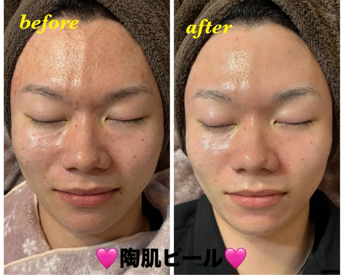 エステ ハーブピーリング専門 毛穴洗浄❤️眉waxのエステ・リラクイメージ