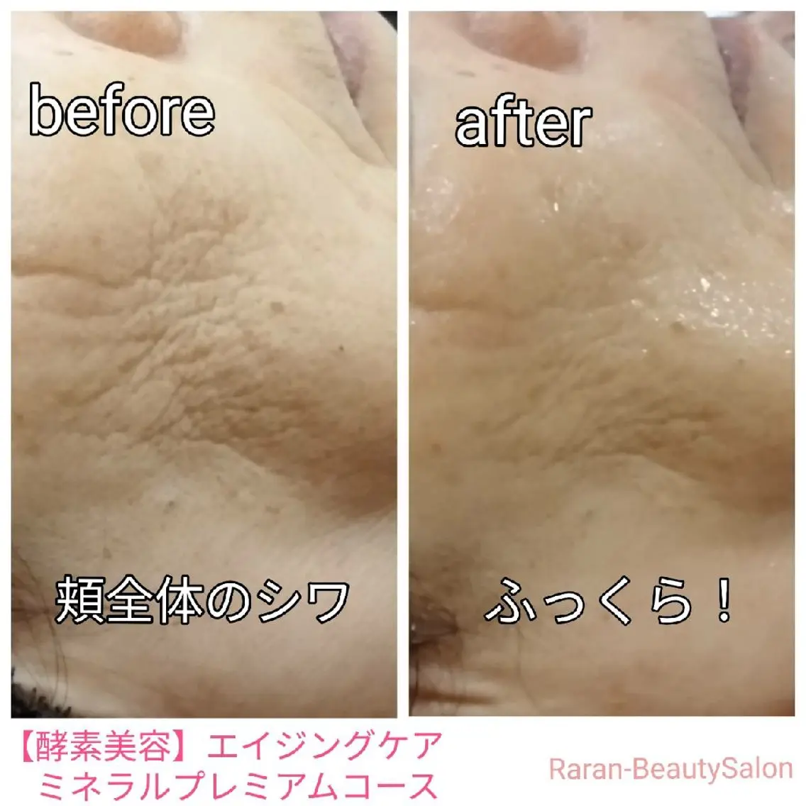最強スペシャルエステ誕生♥️【ミネラル酵素美容* エイジングケアコース】 ハリ✨艶✨くすみ✨の写真