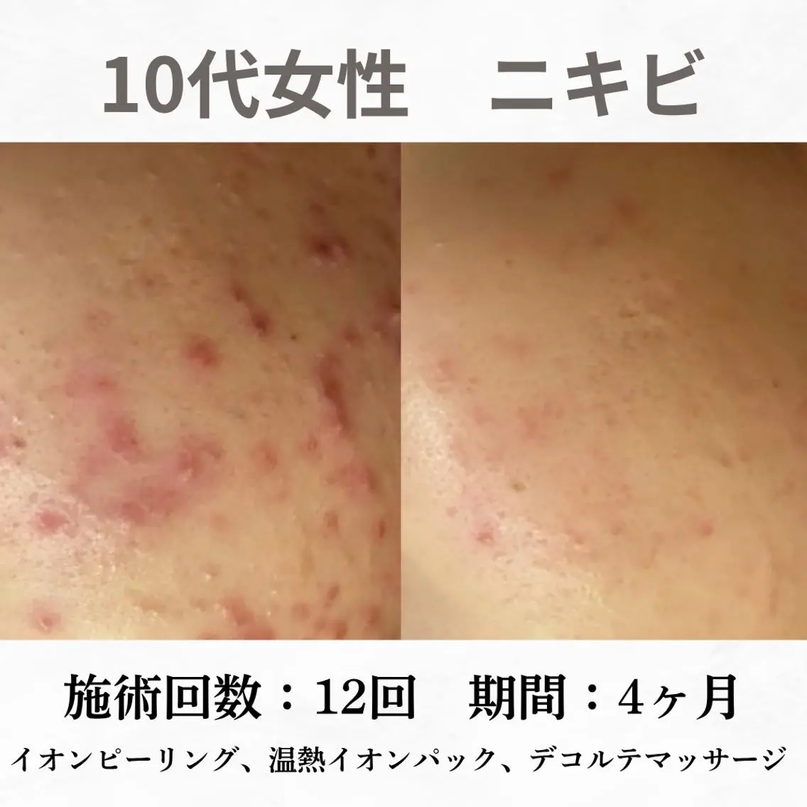 重度ニキビ専門🌼 ダウンタイムなしのエステ・リラクイメージ