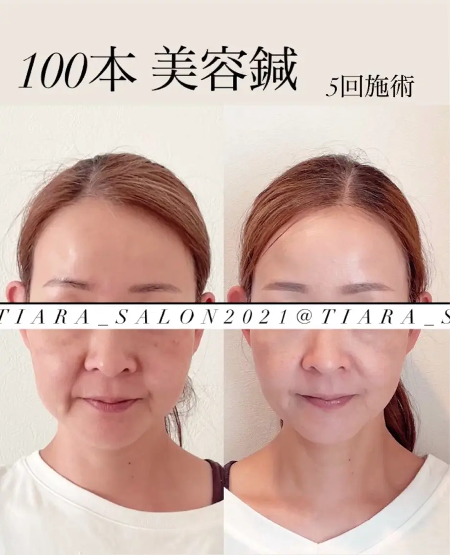 鍼灸サロン TIARA　美容鍼のエステ・リラクイメージ