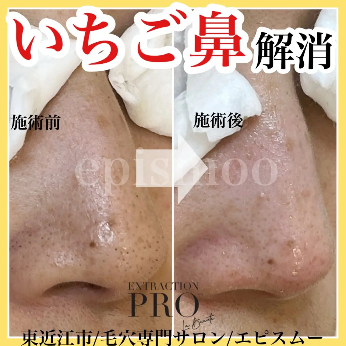 epismoo 脱毛/HBL/毛穴の眉毛・アイブロウイメージ