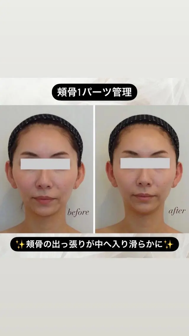 【本物の小顔矯正】痛みなし❣️オールハンドで叶う✨整形級小顔40分の写真