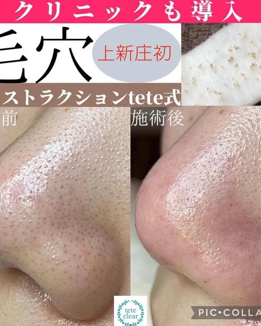 《上新庄初‼︎》毛穴エクストラクション（鼻のみ）の写真