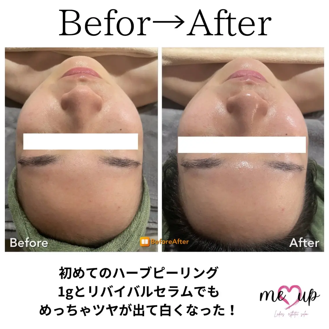 エステ Meupニキビ専門店 背中/ハーブ/肌管理のその他イメージ