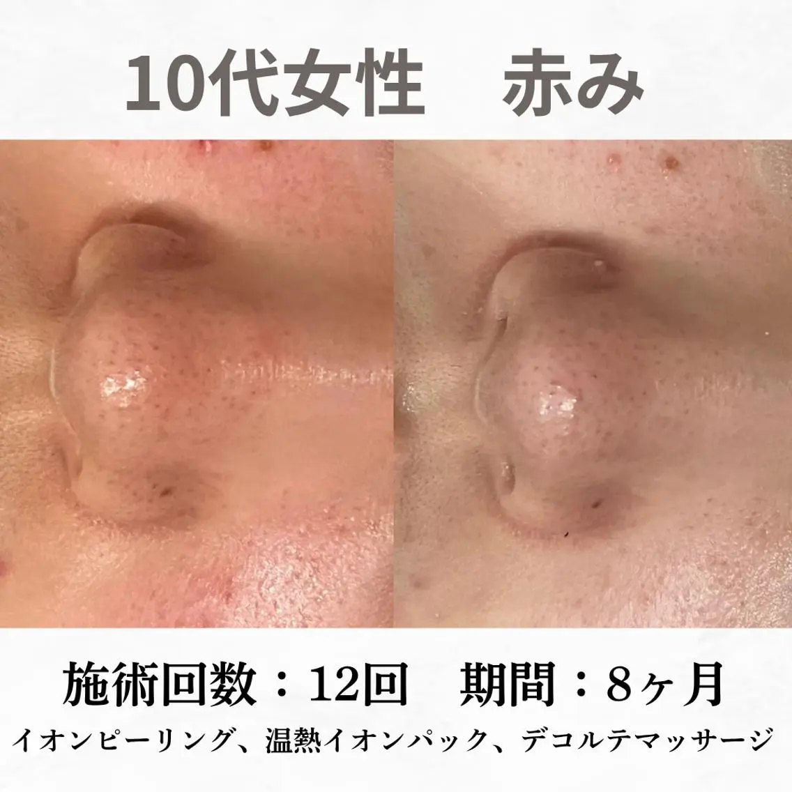 重度ニキビ専門🌷 ダウンタイムなしのエステ・リラクイメージ