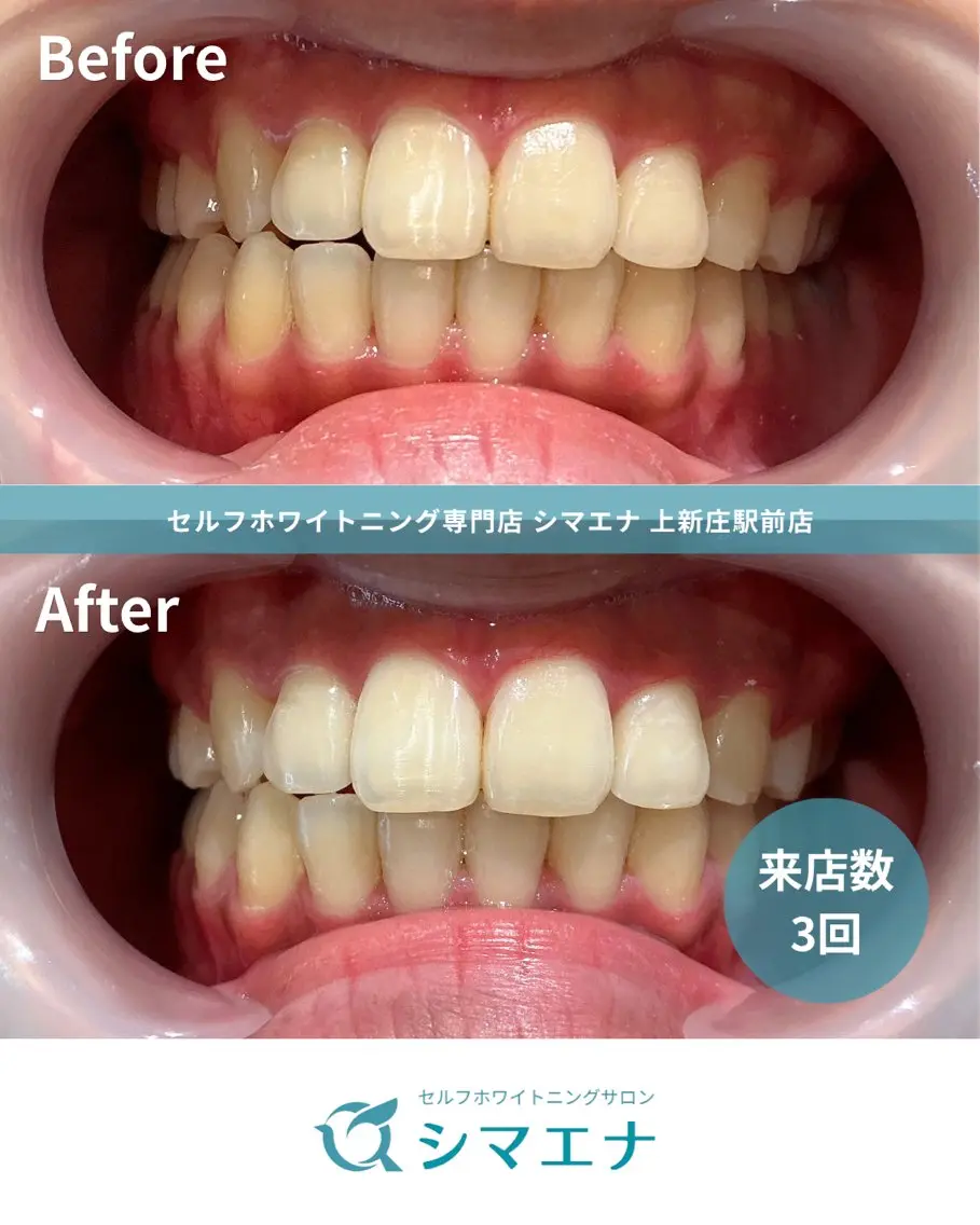 セルフホワイトニング シマエナのその他イメージ