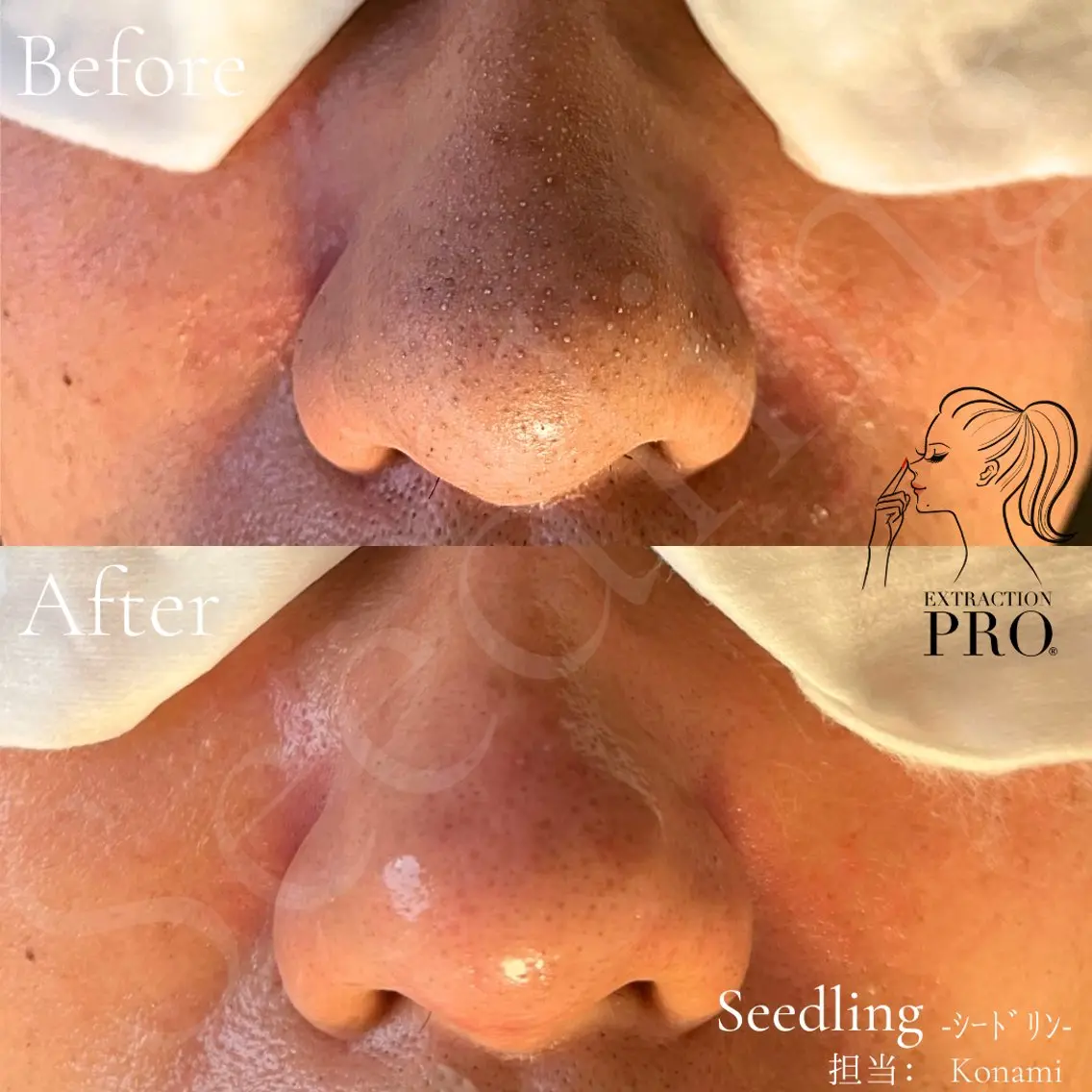 【フェイシャル】メンズも🆗毛穴のお悩み解決✖️スッキリ小顔に💫スペシャルフェイシャル🧖🏻‍♀️の写真
