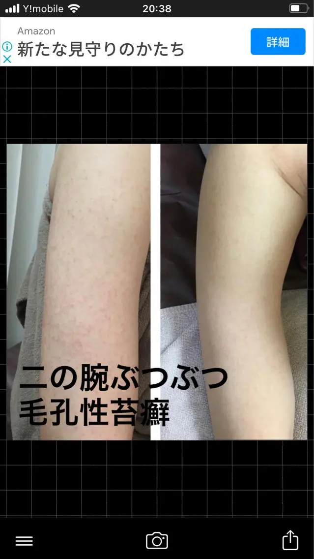 速攻✨💕肌質改善‼️背中orお尻or二の腕のハーブピーリング🌿（剥離あり/ノーマル）ニキビ、ニキビ跡、毛孔性苔癬の写真