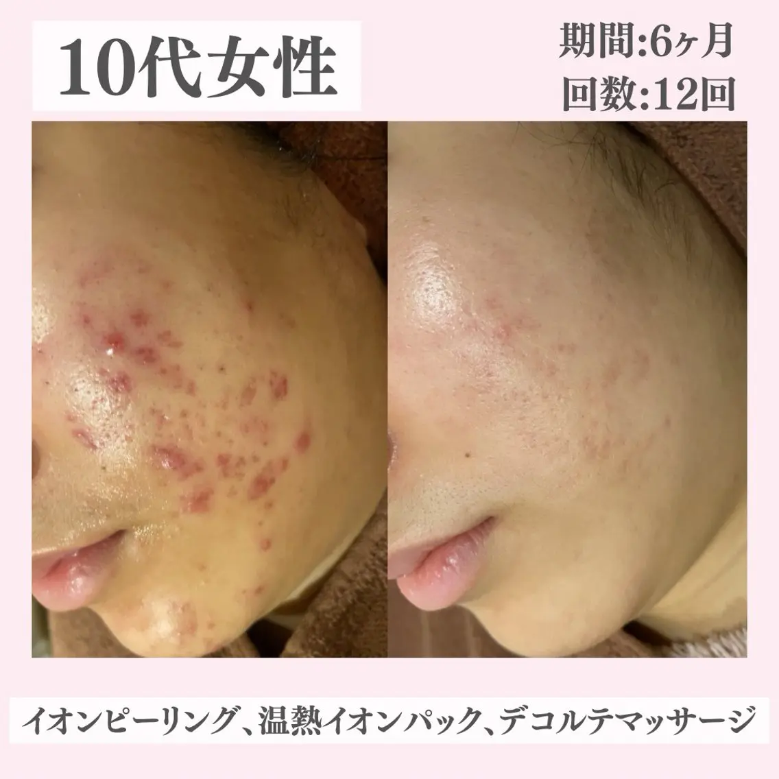 エステ リラク ニキビ・肌質改善専門 ♡人生が変わるサロンのエステ・リラクイメージ