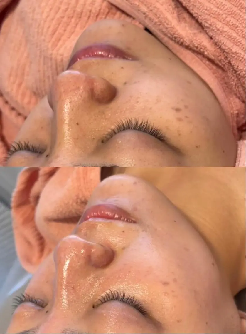 【ダウンタイム0日】韓国最新！ハーブピーリング🌿その日に剥けるので当日お化粧可能！お写真モニター様価格で激安価格挑戦！の写真