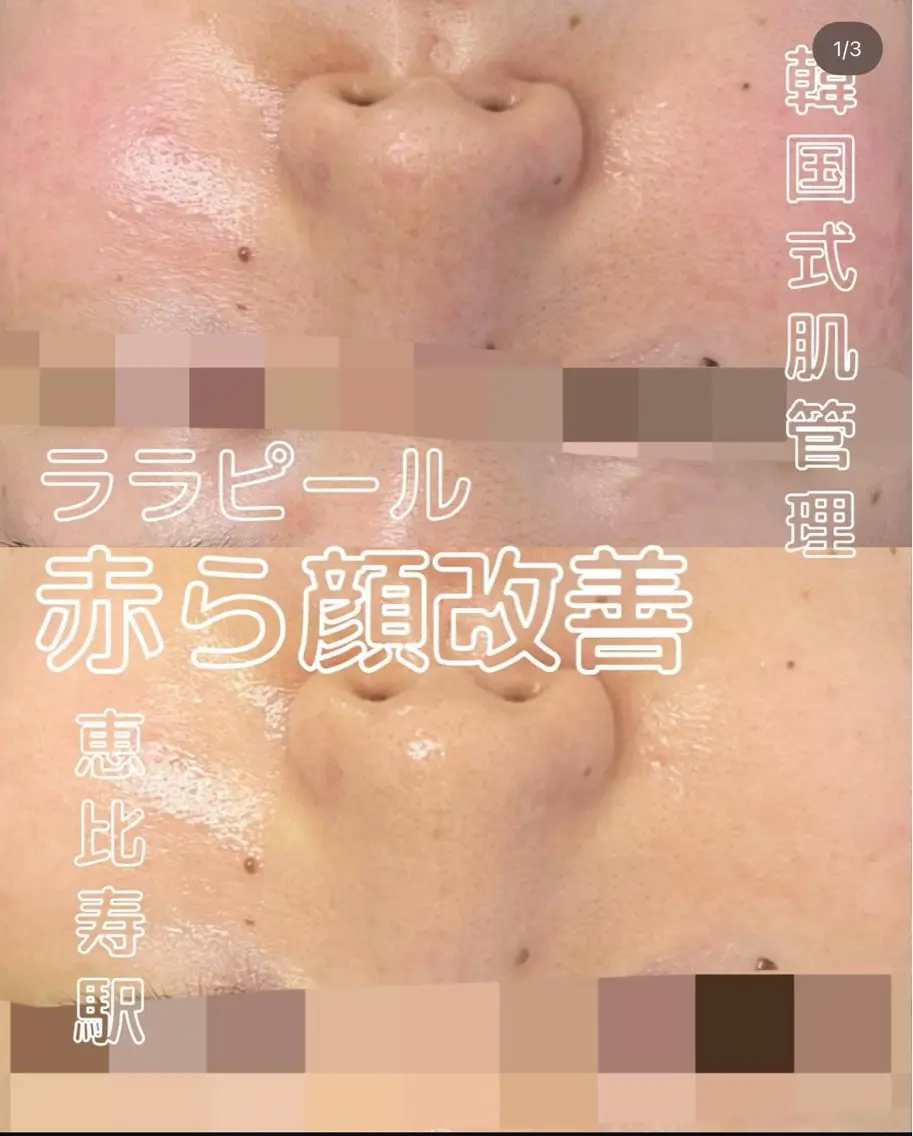 韓国式ピーリング|ツヤ肌ケア🫧の写真