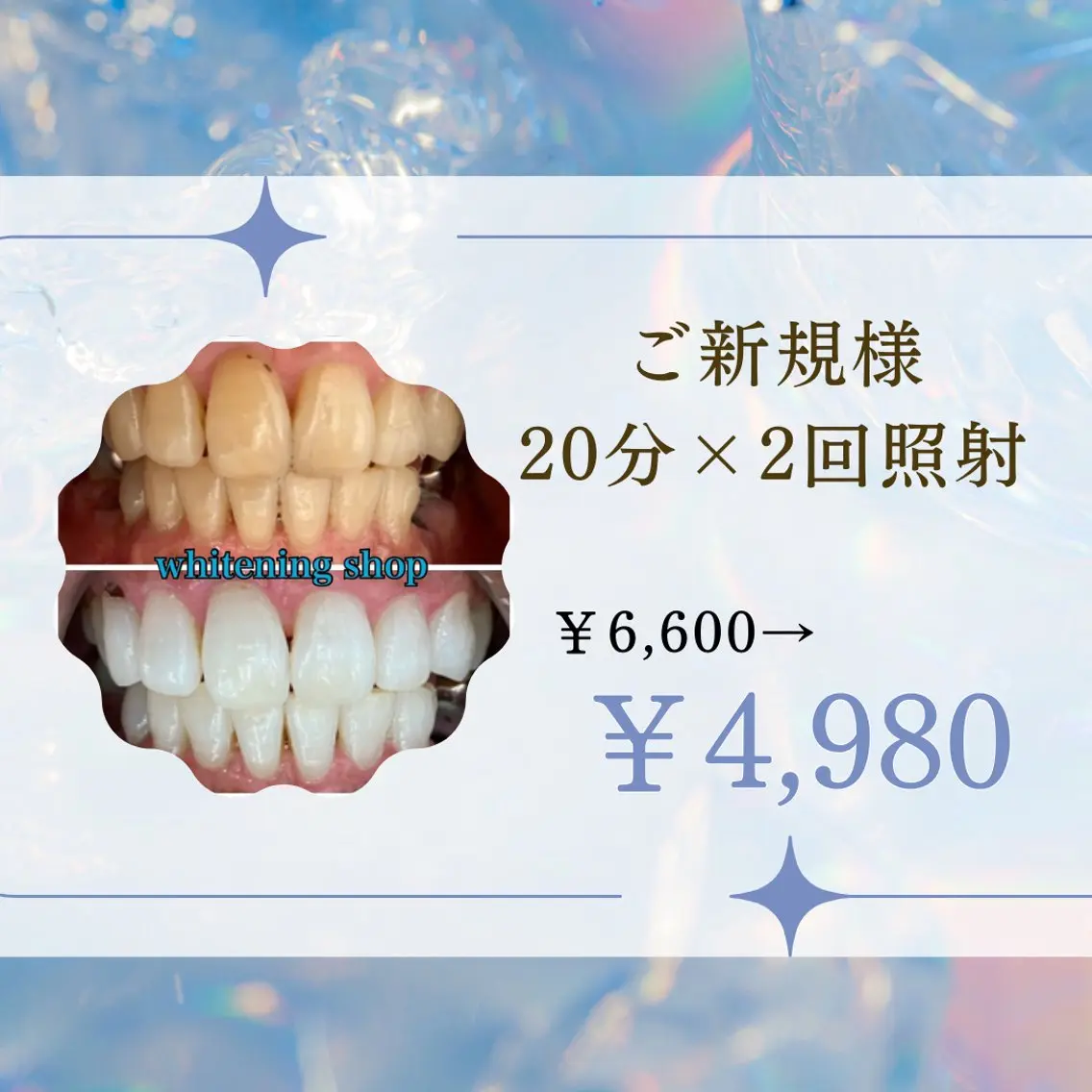 ご新規様限定☆歯の黄ばみを徹底解消!セルフホワイトニング20分×2回照射通常¥4,980の写真