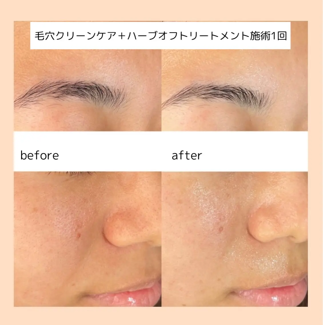 月1回のスペシャルケア🧖🏻♀️人気No1毛穴クリーンケア+贅沢🌿ハーブオフトリートメントの写真