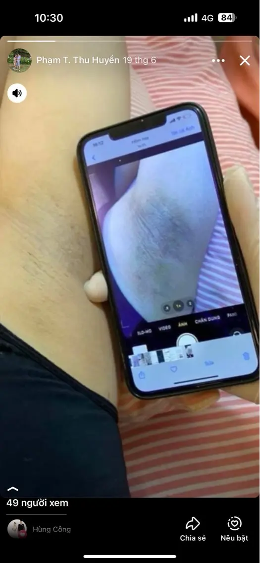 脇脱毛の写真
