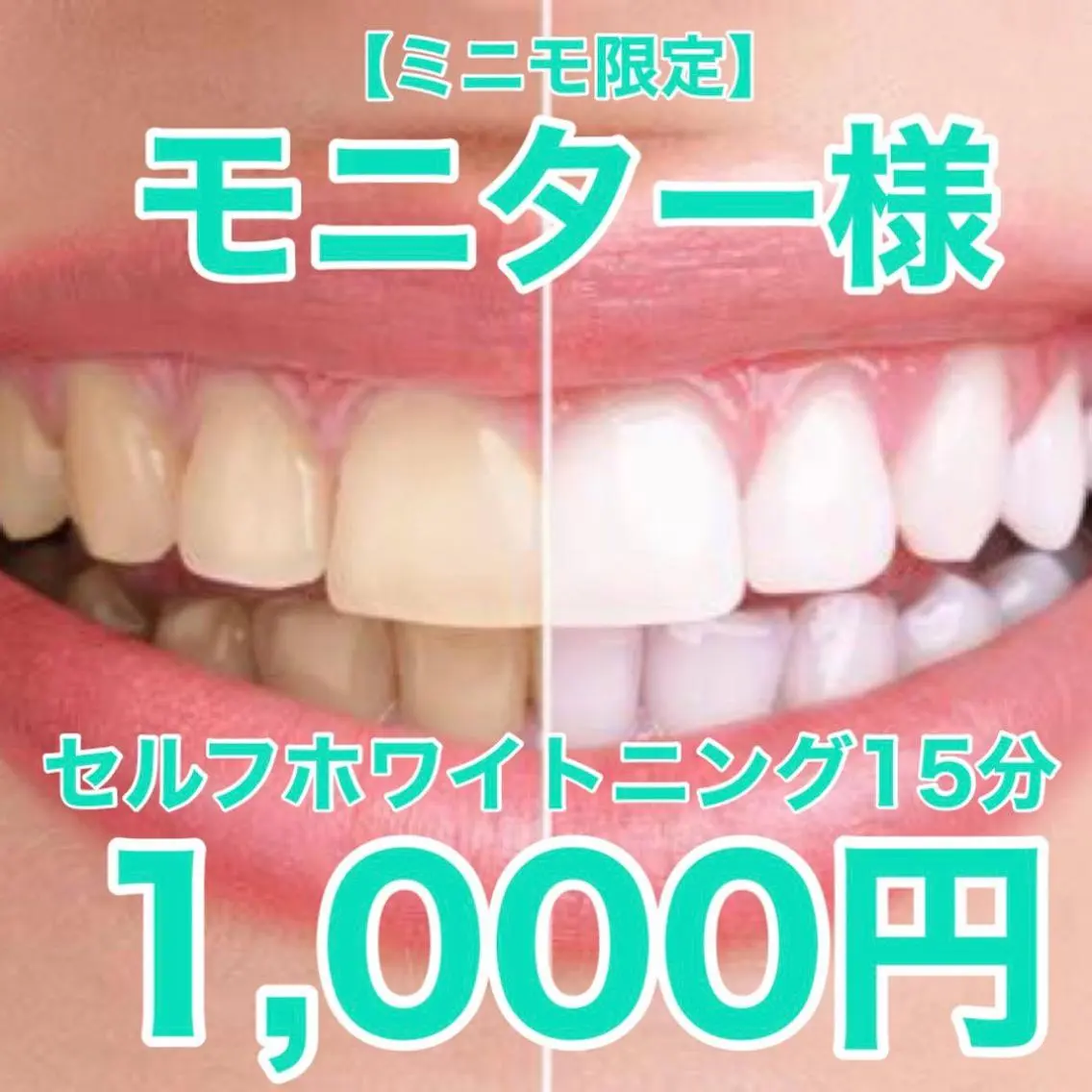 📸《ミニモ限定》セルフホワイトニングモニター様募集🦷✨15分／1,000円（税込）💰の写真