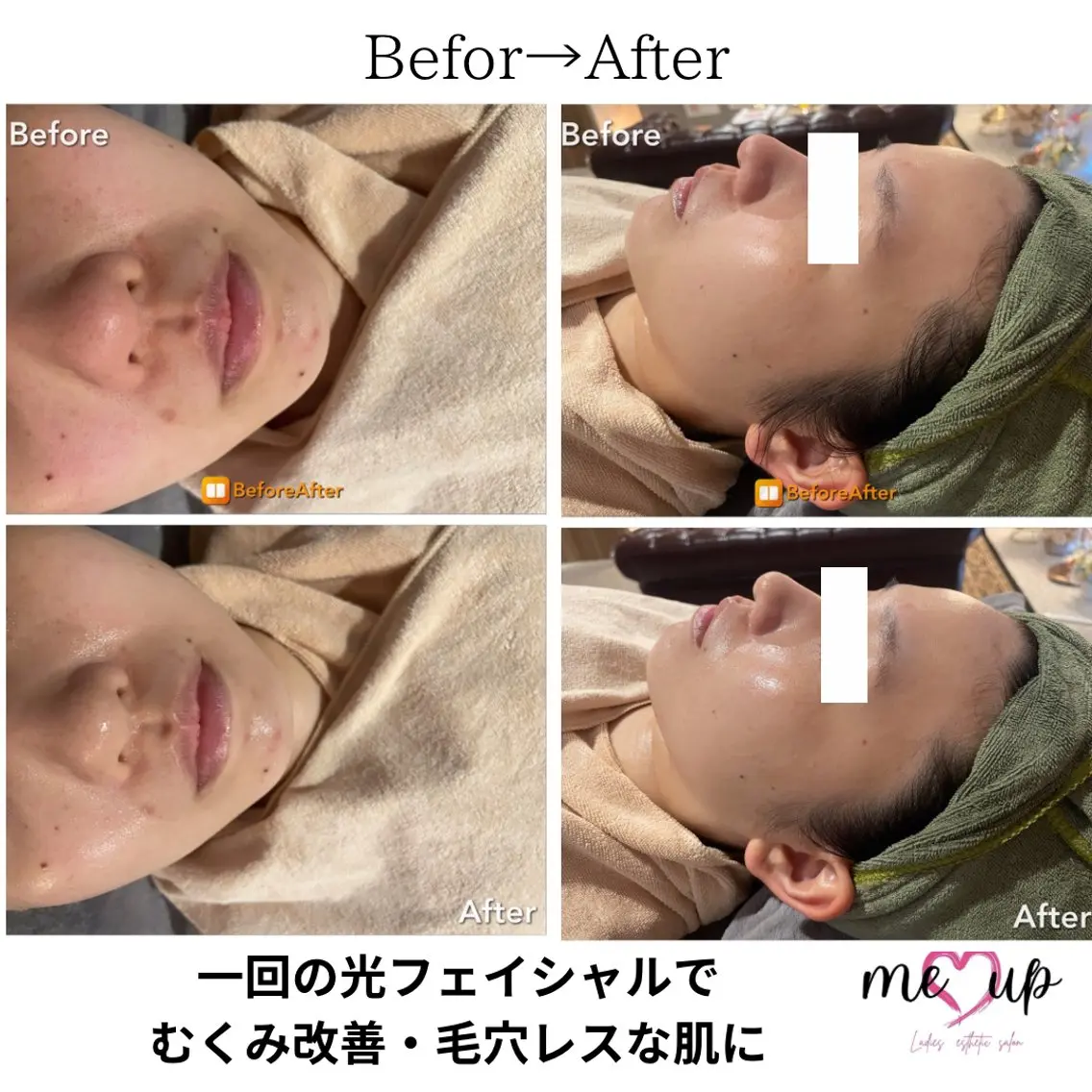 エステ Meupニキビ専門店 背中/ハーブ/肌管理のその他イメージ