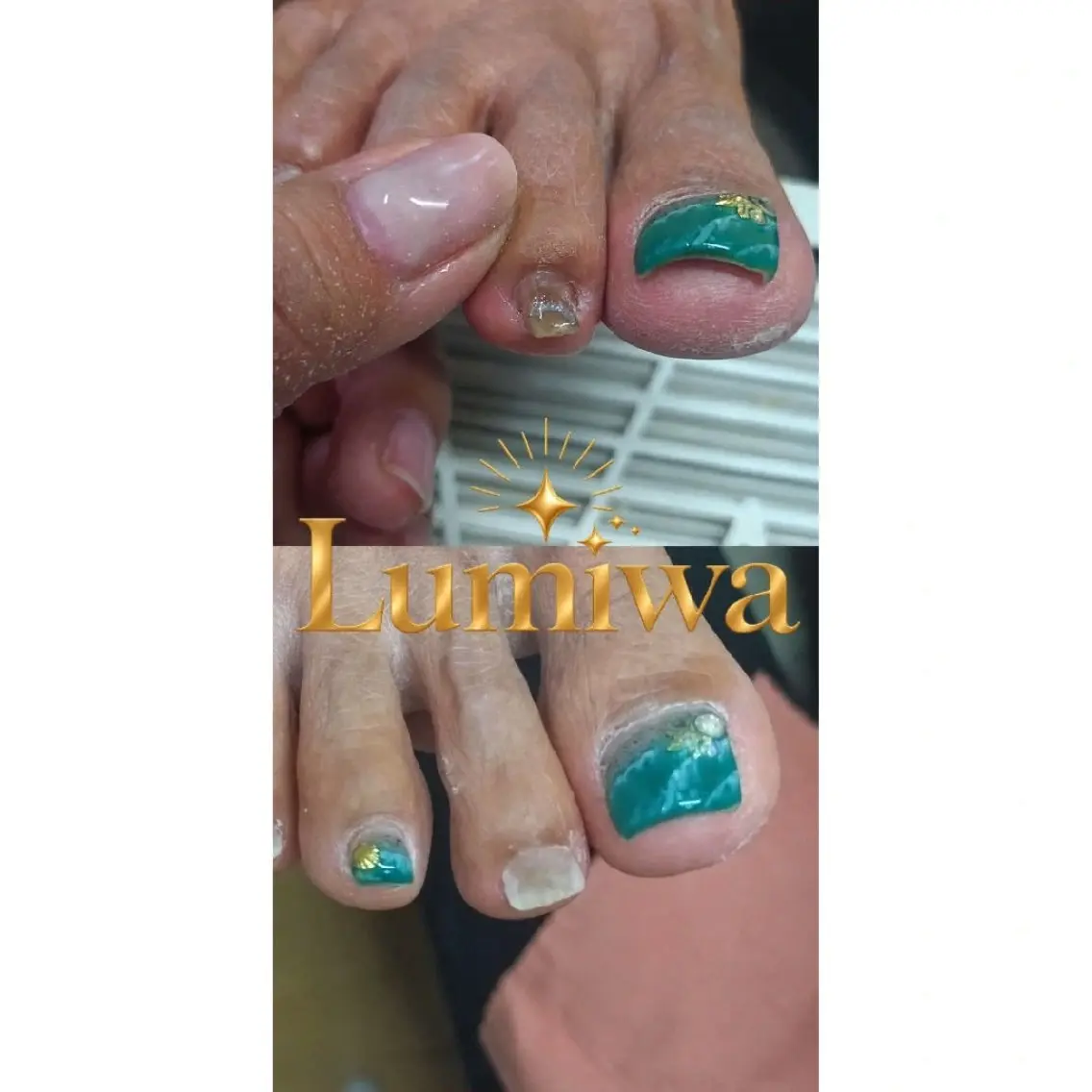 巻き爪補正(親指以外)1本の写真