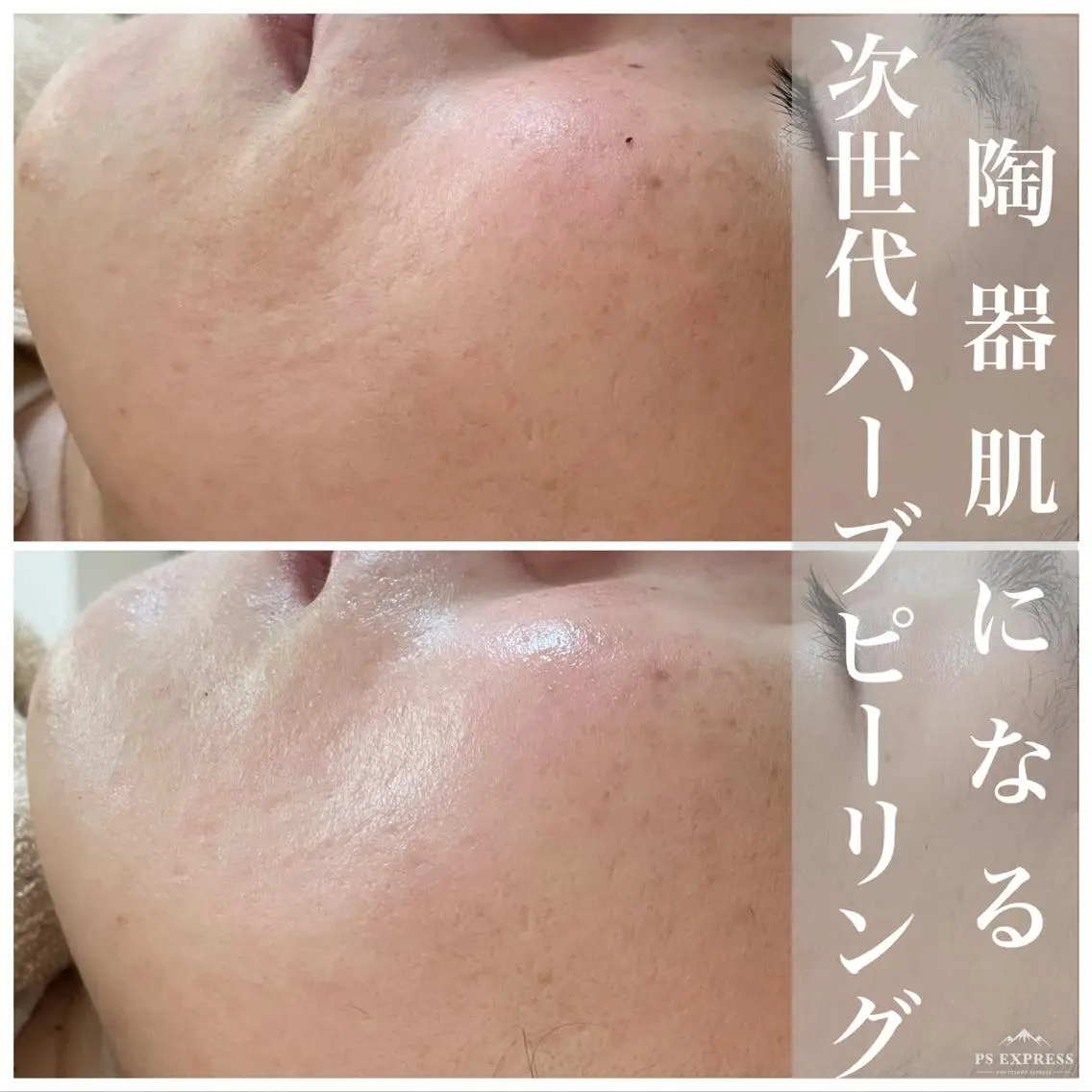 ネイル マツエク・マツパ アイブロウ 卒業式 エステ ニキビ・毛穴改善 🌿ハーブピーリングのエステ・リラクイメージ