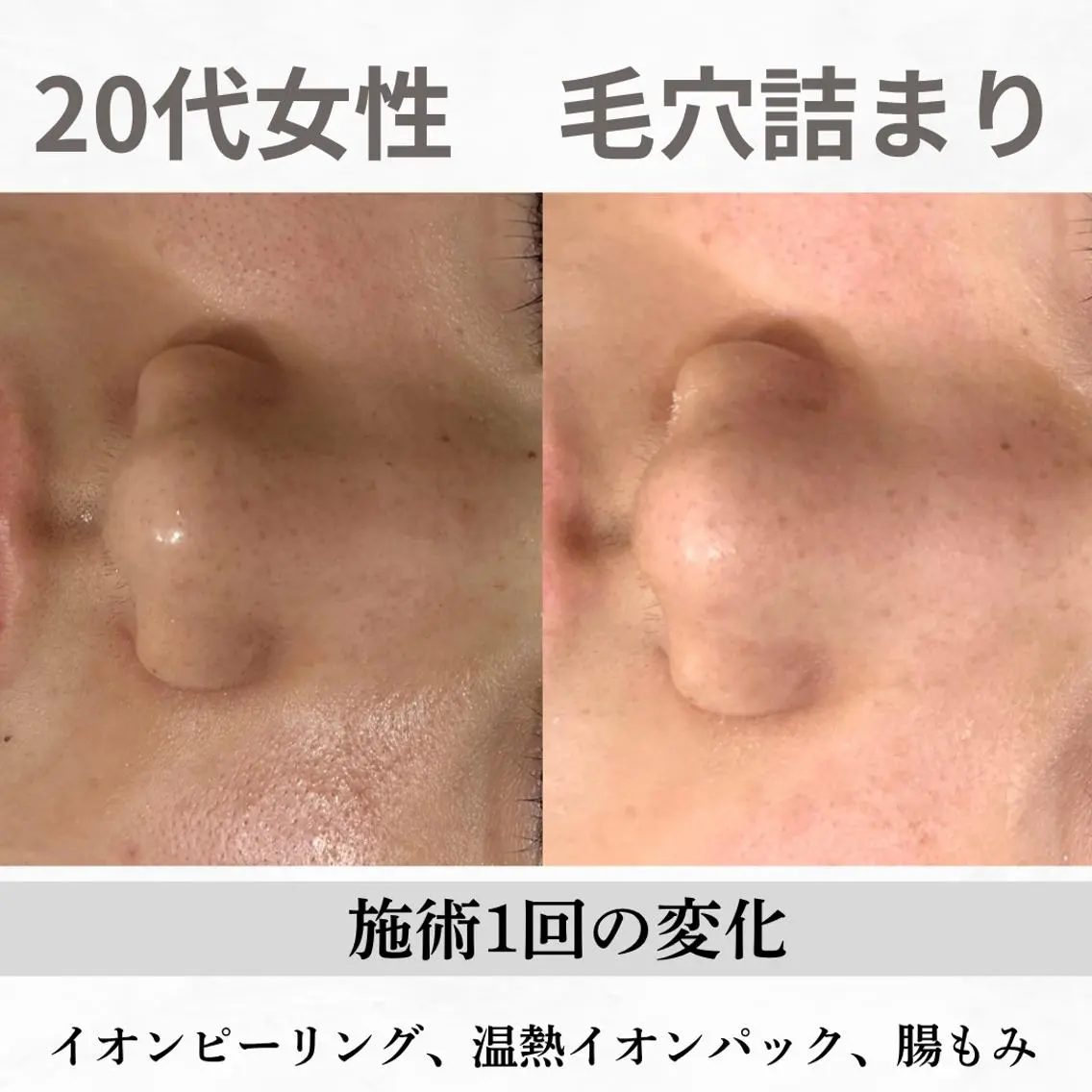 重度ニキビ専門🌷 ダウンタイムなしのエステ・リラクイメージ