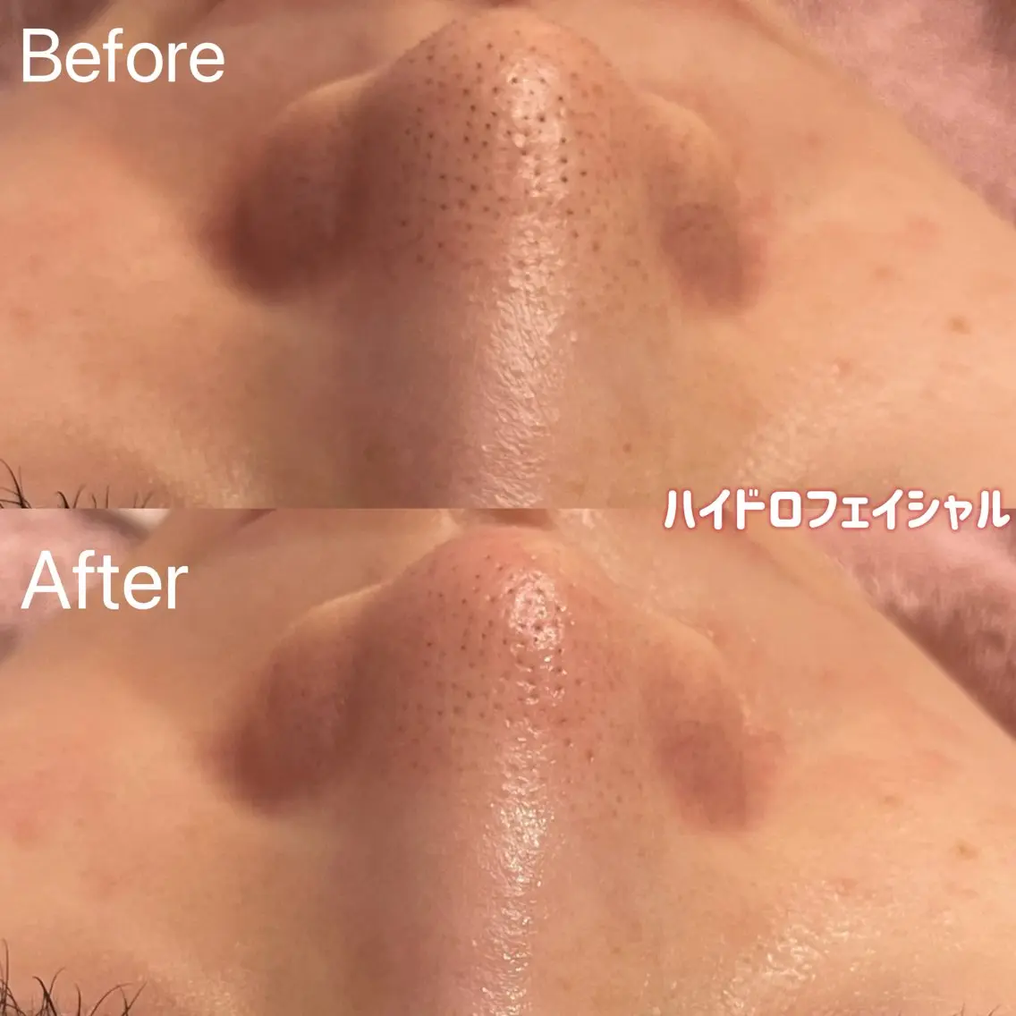 エステ 小顔&毛穴・肌質改善 LINDA西宮 AIのエステ・リラクイメージ