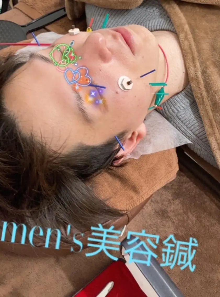 men's美容鍼✨【平日限定】の写真