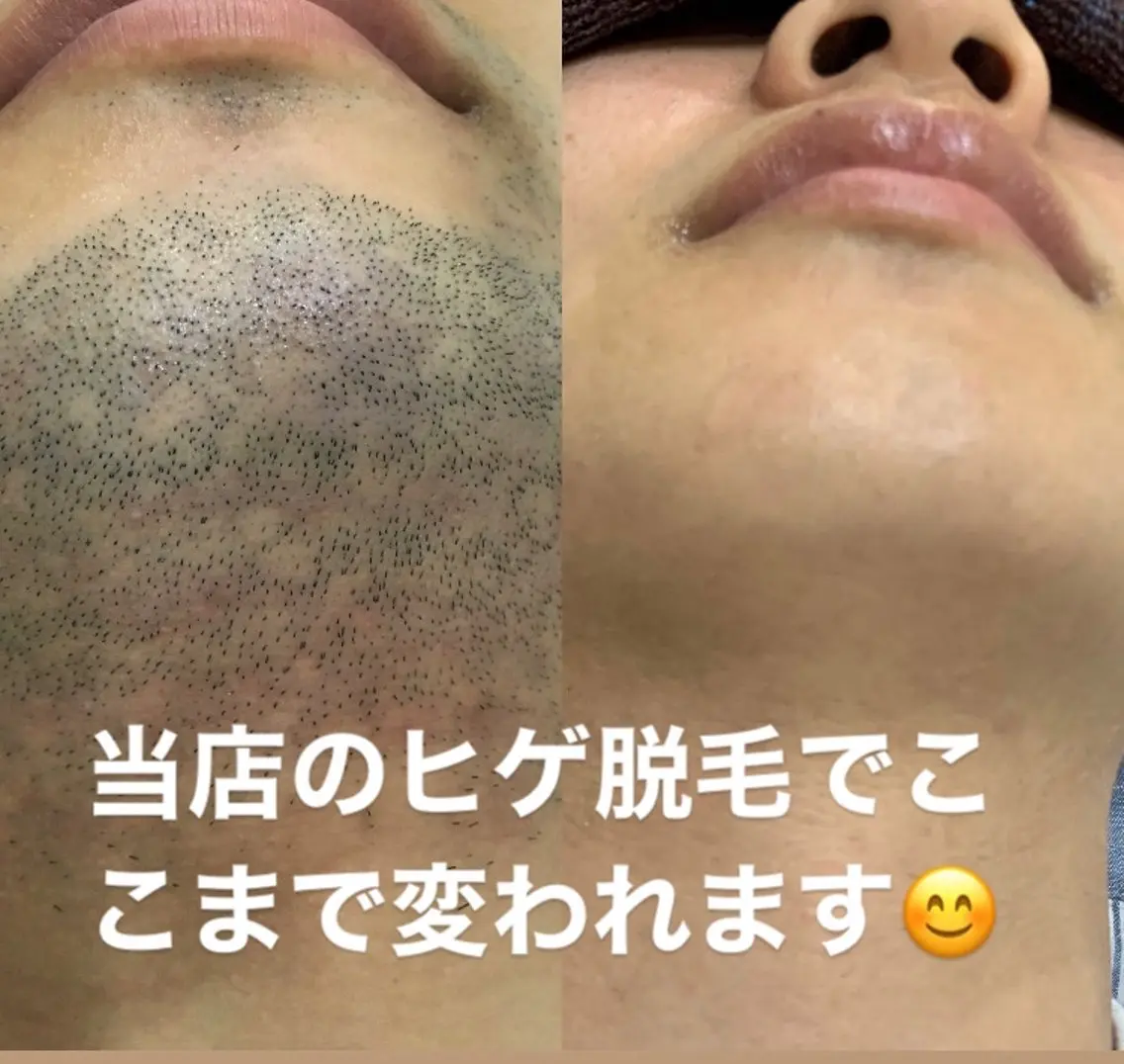 【メンズ脱毛】人気No1 初回お試しヒゲ脱毛！髭をなくして髭剃り卒業しましょう！髭剃りしたくない！モテたい男子はこれ！の写真