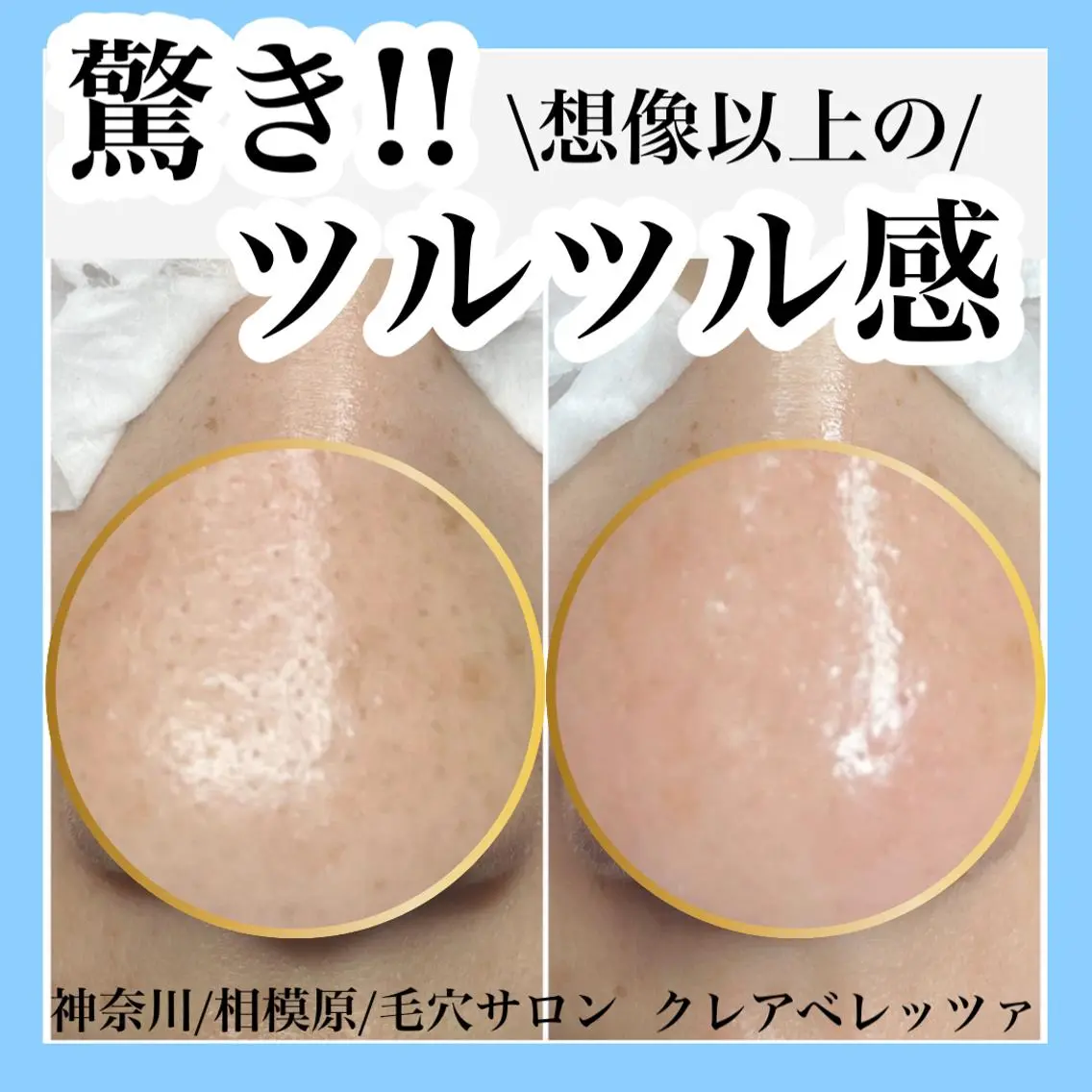 学生/新社会人の方向け。毛穴ケアすっきりメニュー⭐️鼻の黒ずみやざらつき、化粧ノリが気になる方におすすめ⭐️の写真