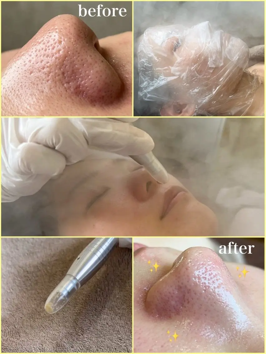 溶ける角栓【毛穴吸引】引き締めパック&鎮静パック付き👃気になる鼻&顎&眉間の部分ケア¥4980✨の写真