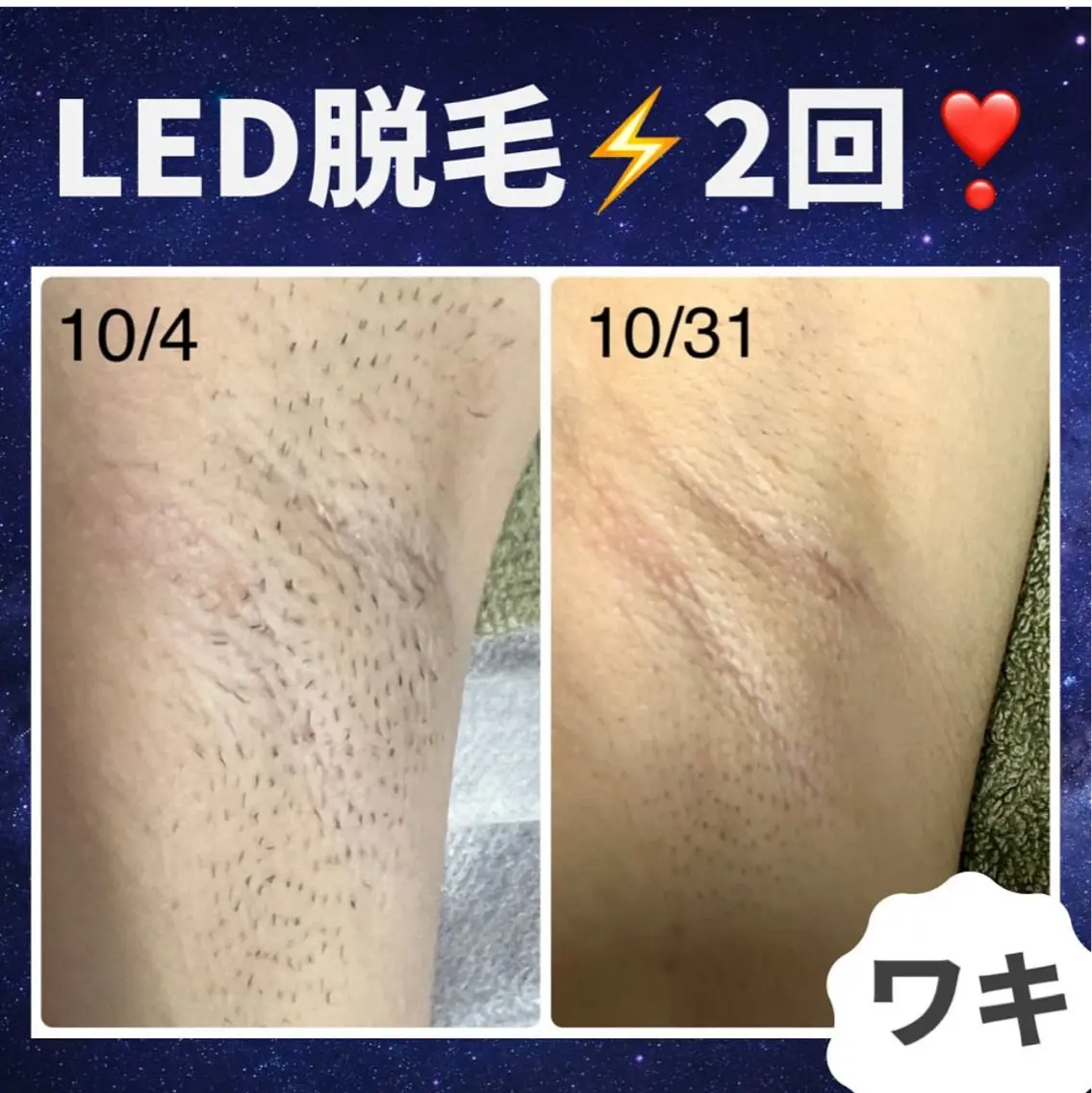 脱毛🌿両わきの写真