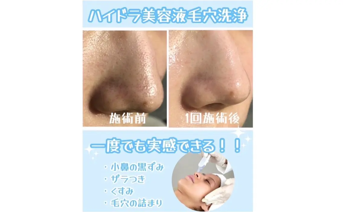 💎😻毛穴洗浄💎毛穴丸ごとすべすべに✨の写真